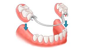 Dentaduras parciales removibles